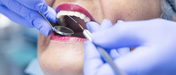 Best Emergency Dental Care for Broken or Chipped Teeth in Utica, NY
